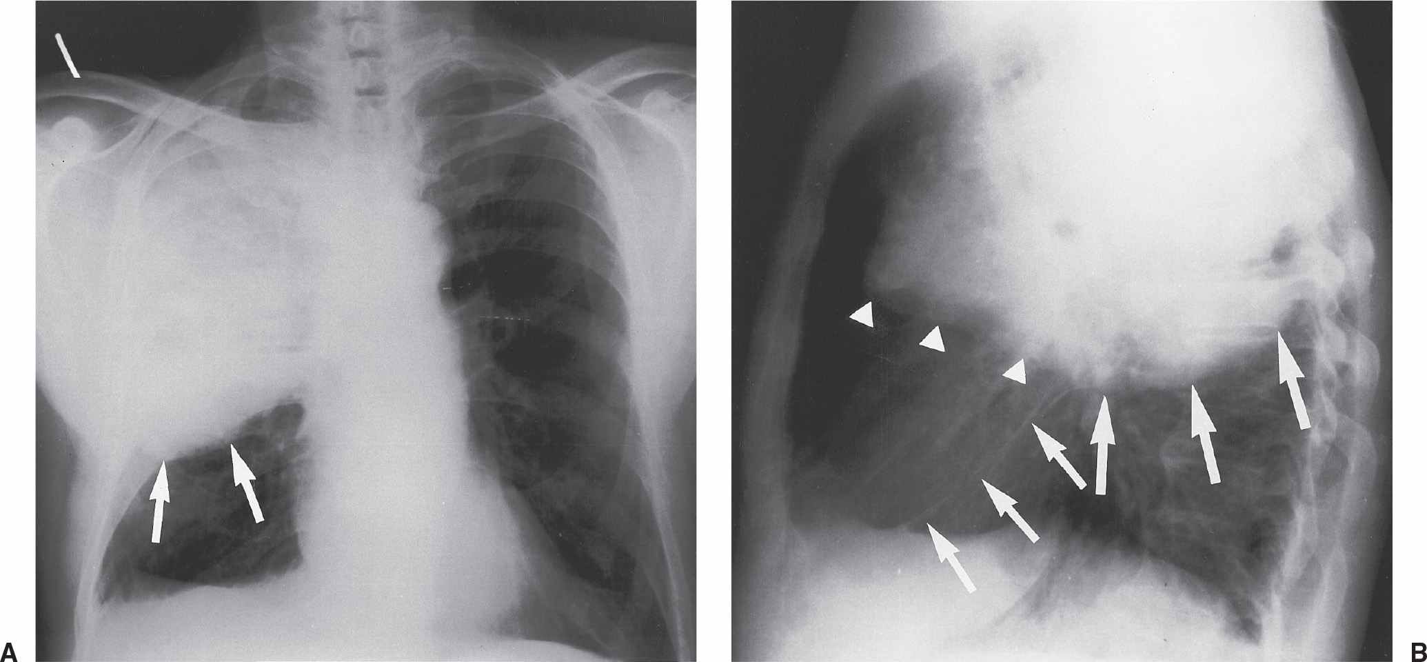Signs and Patterns of Lung Disease Radiology Key