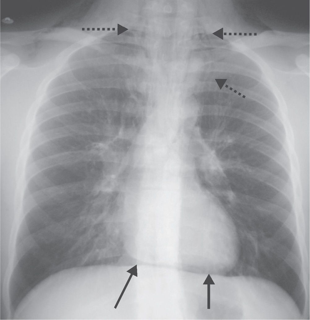 Signs and Patterns of Lung Disease Radiology Key