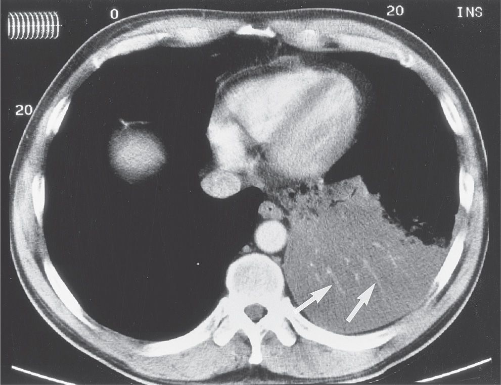 Signs and Patterns of Lung Disease Radiology Key