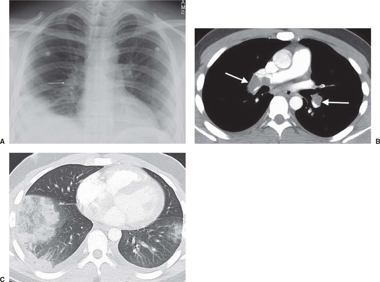 Signs and Patterns of Lung Disease Radiology Key
