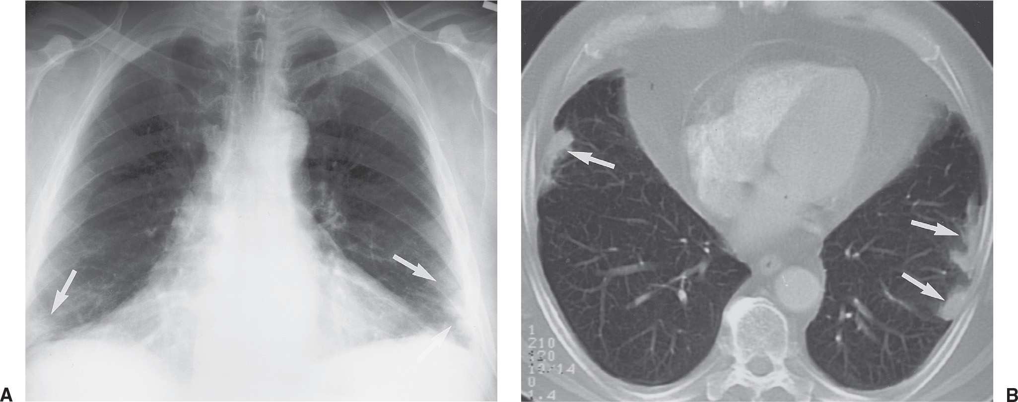 Signs and Patterns of Lung Disease Radiology Key