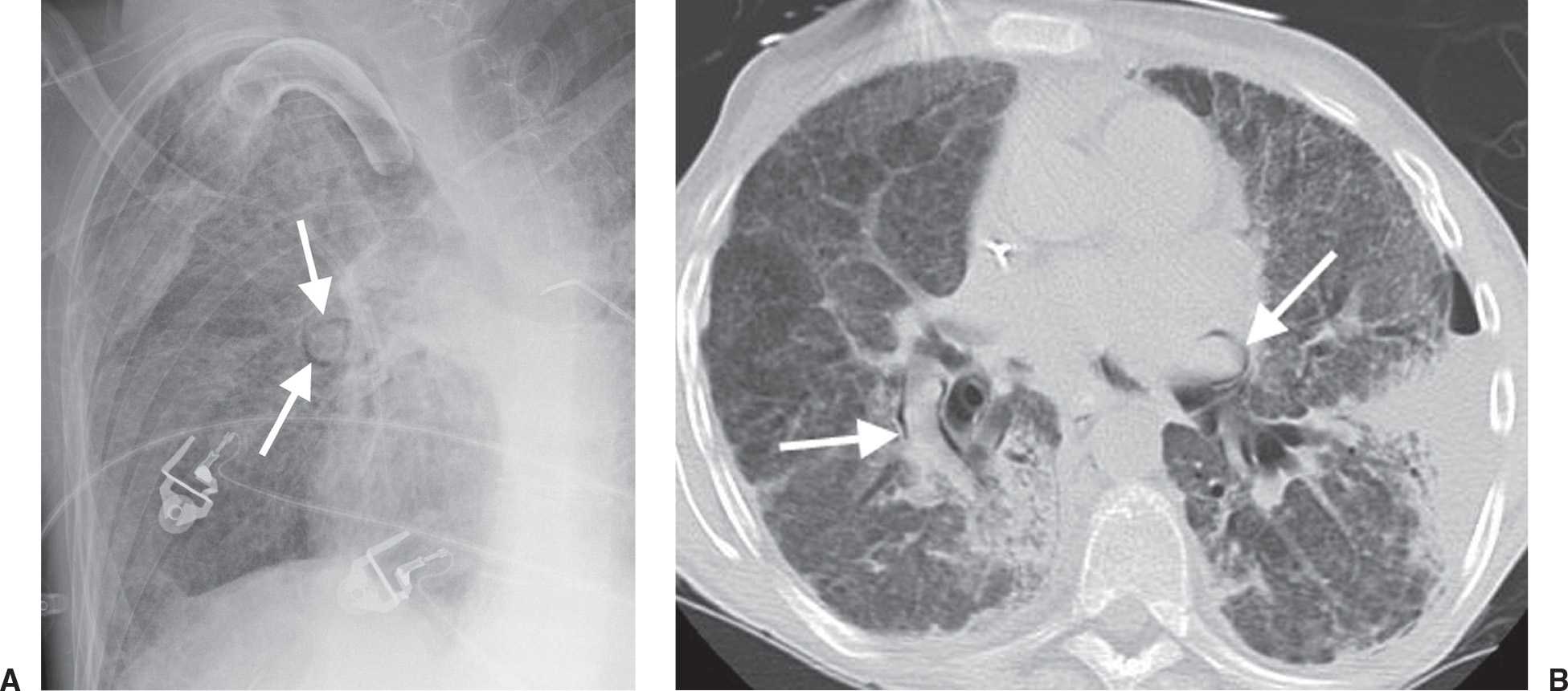 Signs and Patterns of Lung Disease Radiology Key