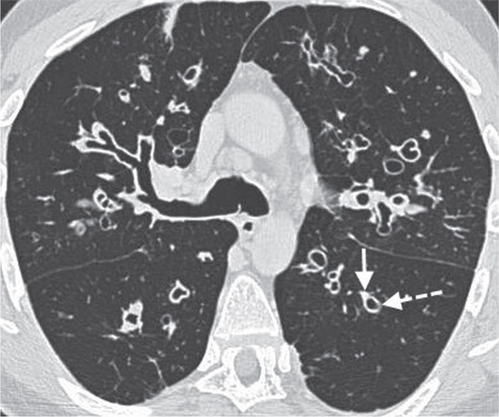 Signs and Patterns of Lung Disease Radiology Key