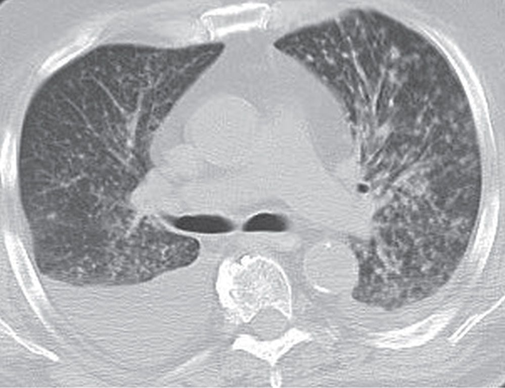 Interstitial Lung Disease Radiology Key