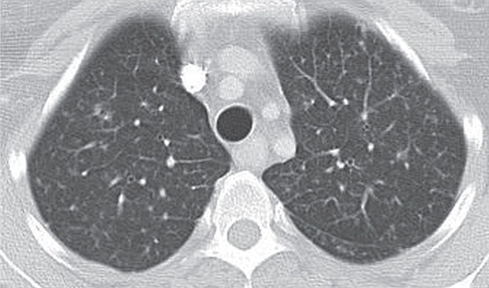 Interstitial Lung Disease Radiology Key