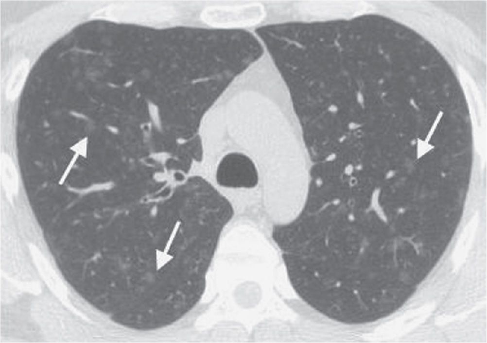 Interstitial Lung Disease Radiology Key