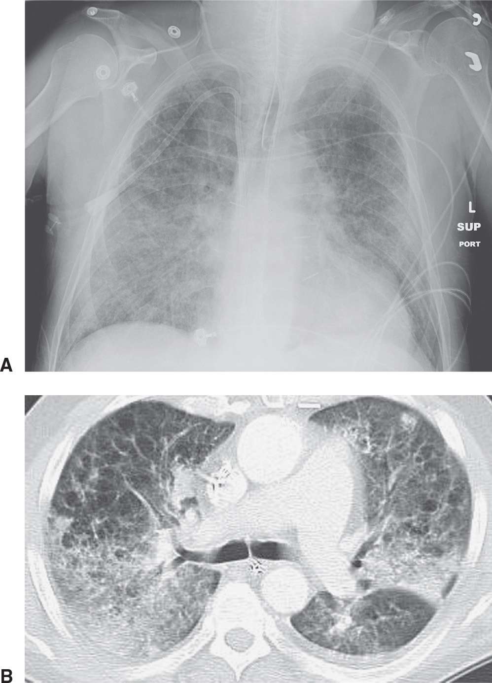 Interstitial Lung Disease Radiology Key