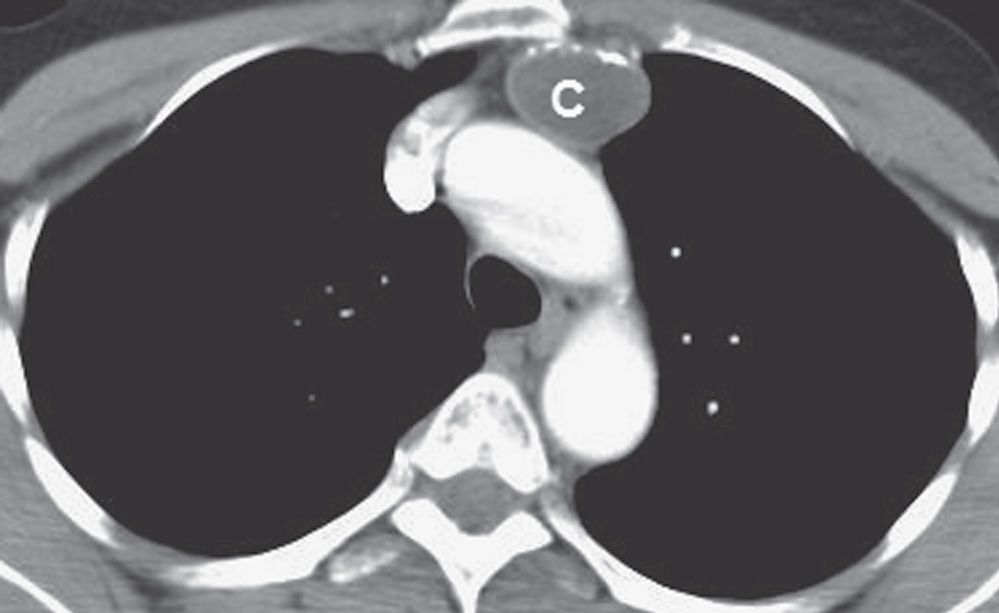 Mediastinal Masses Radiology Key