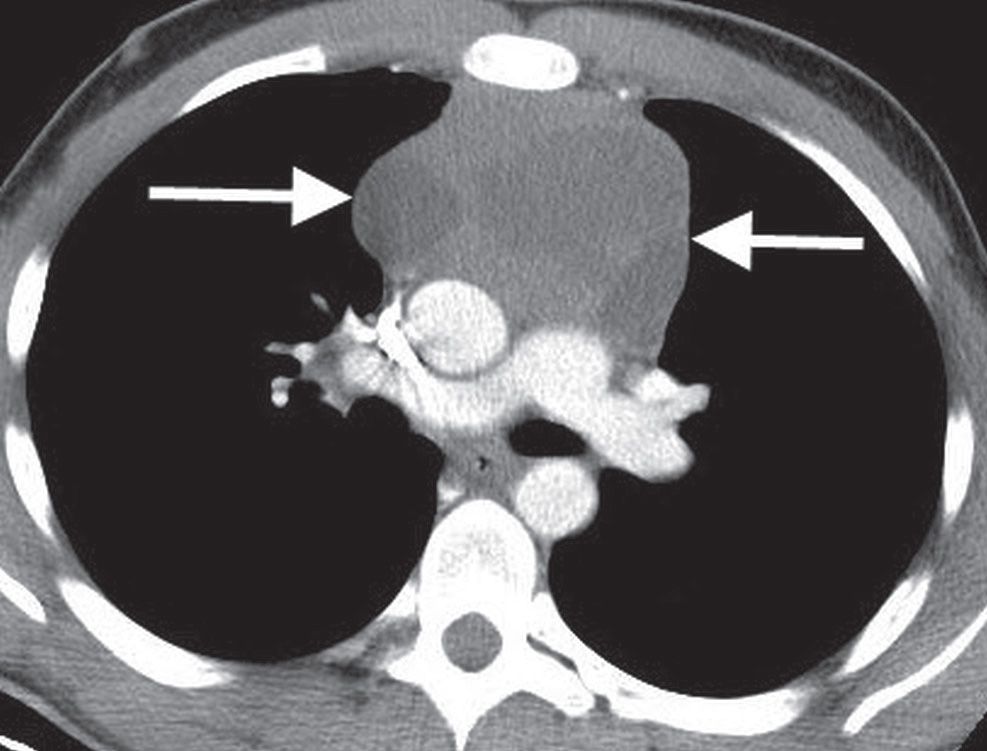 Mediastinal Masses Radiology Key