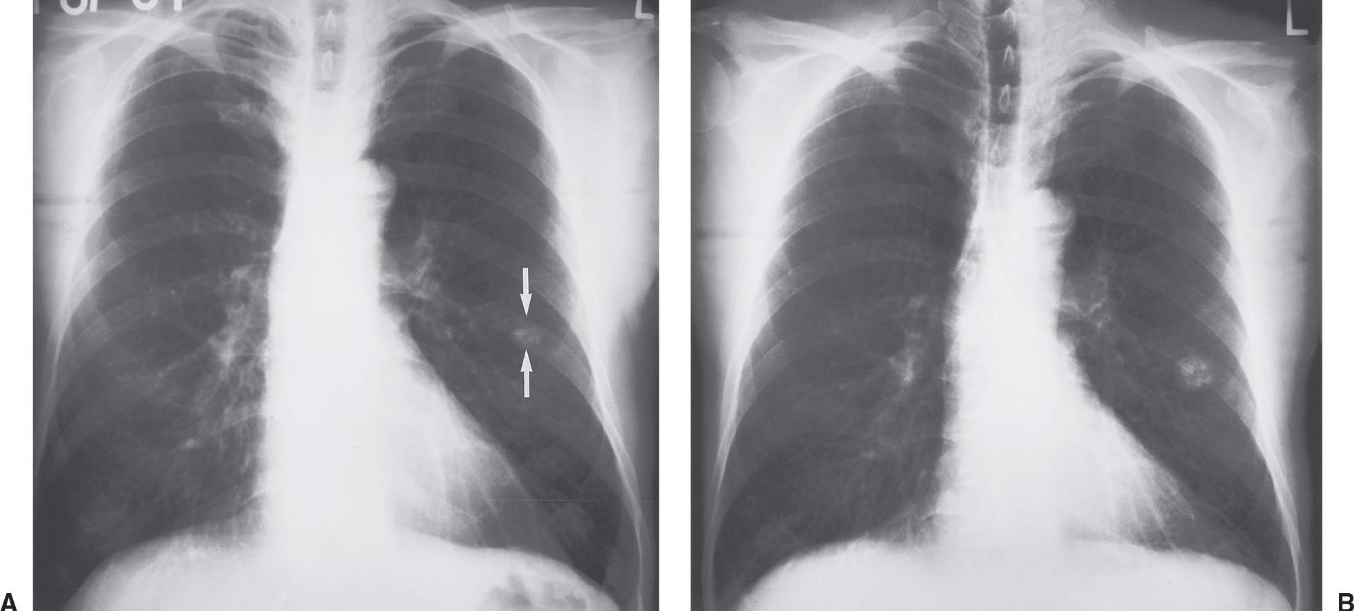 Solitary and Multiple Pulmonary Nodules Radiology Key