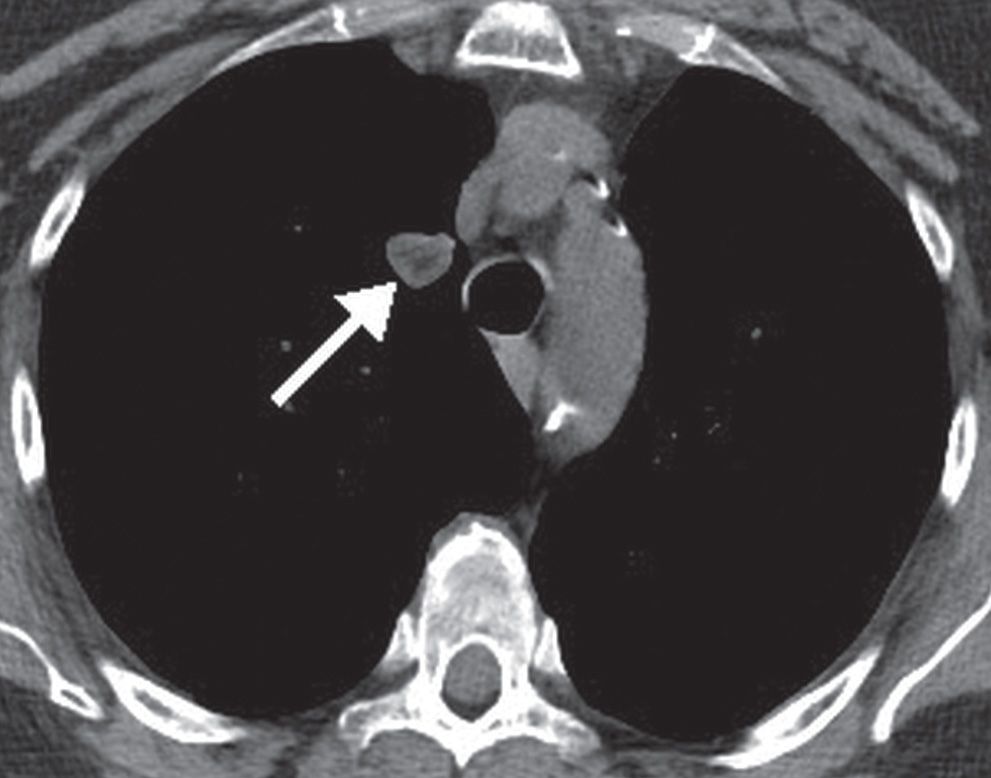 Solitary and Multiple Pulmonary Nodules Radiology Key