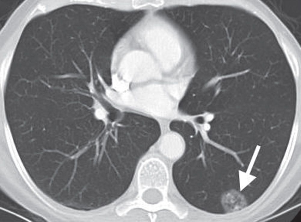 Solitary and Multiple Pulmonary Nodules Radiology Key