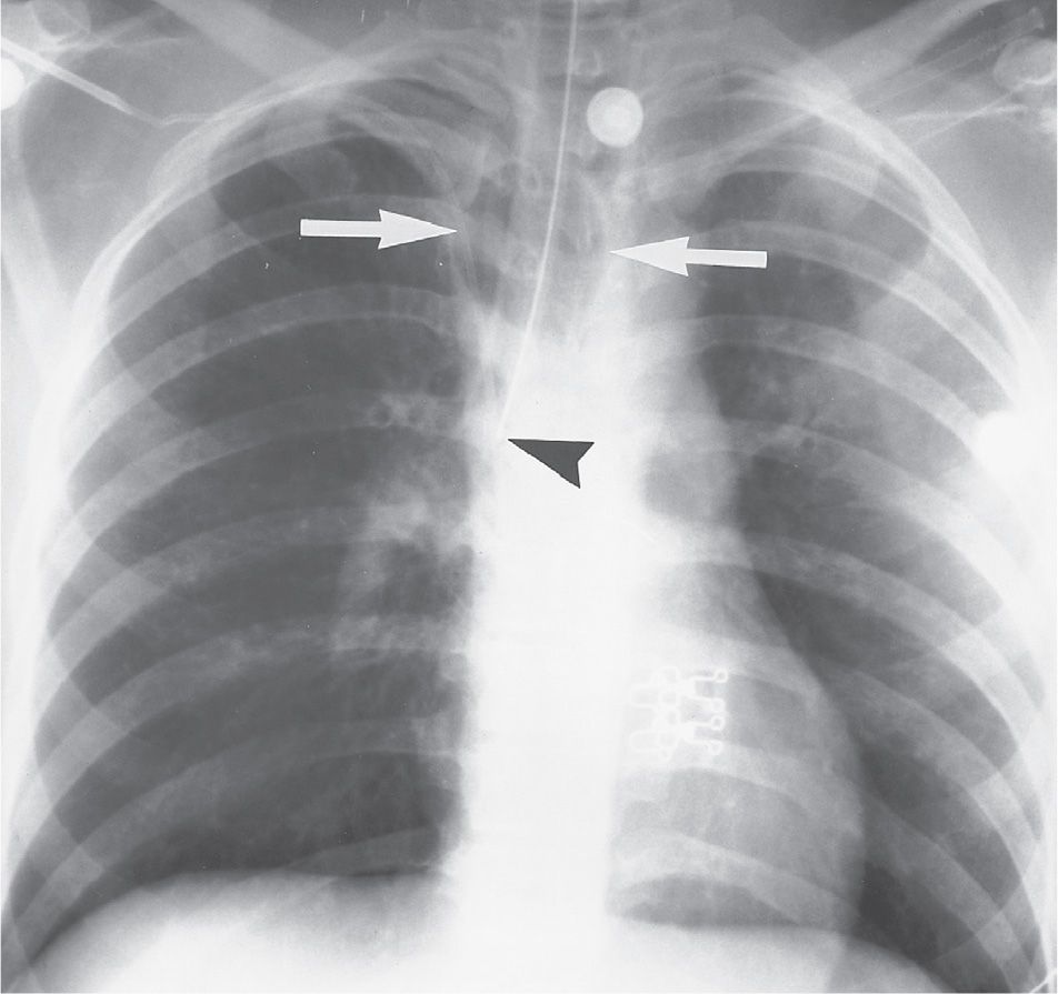 Chest Trauma Radiology Key