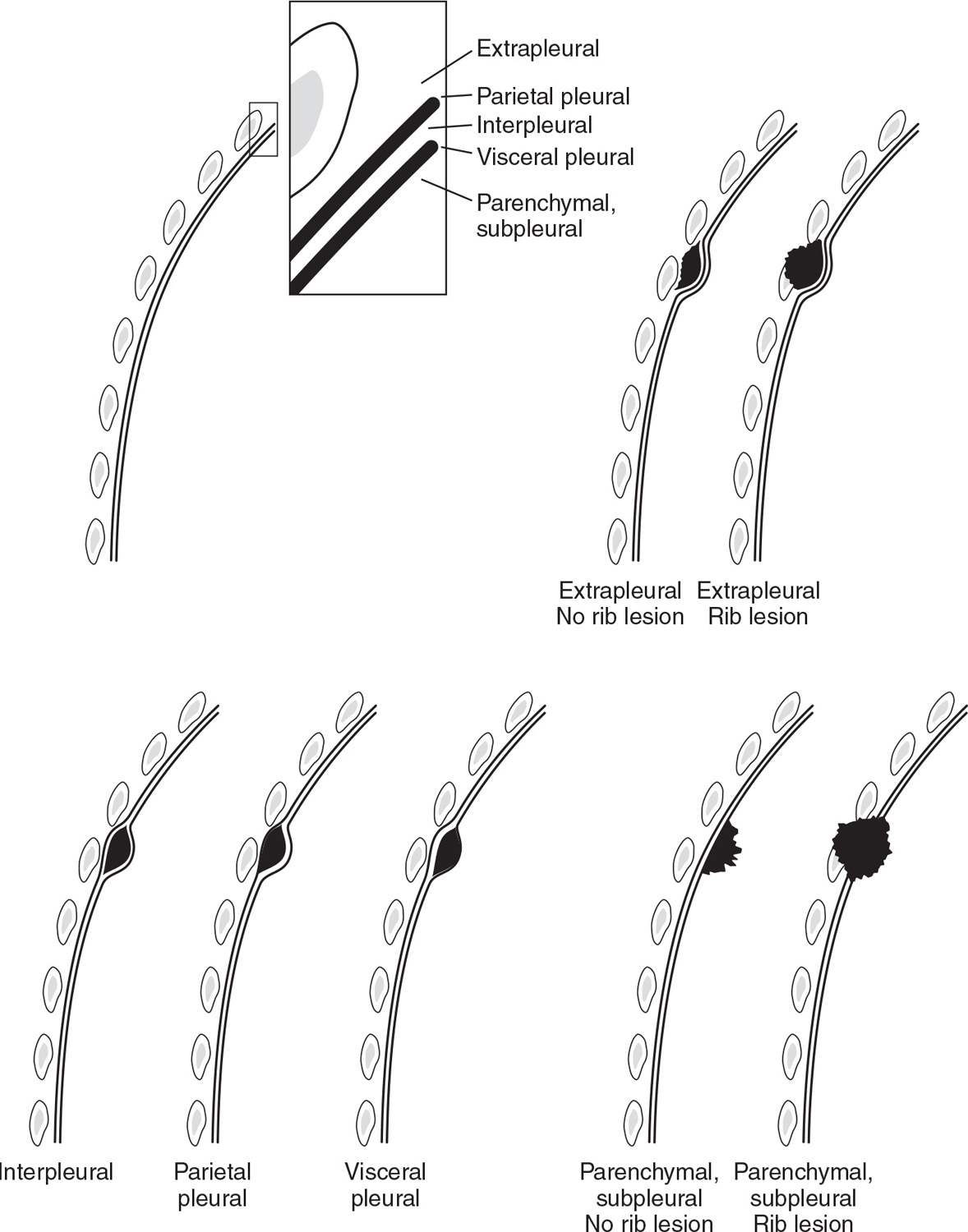 Pleura, Chest Wall, and Diaphragm Radiology Key