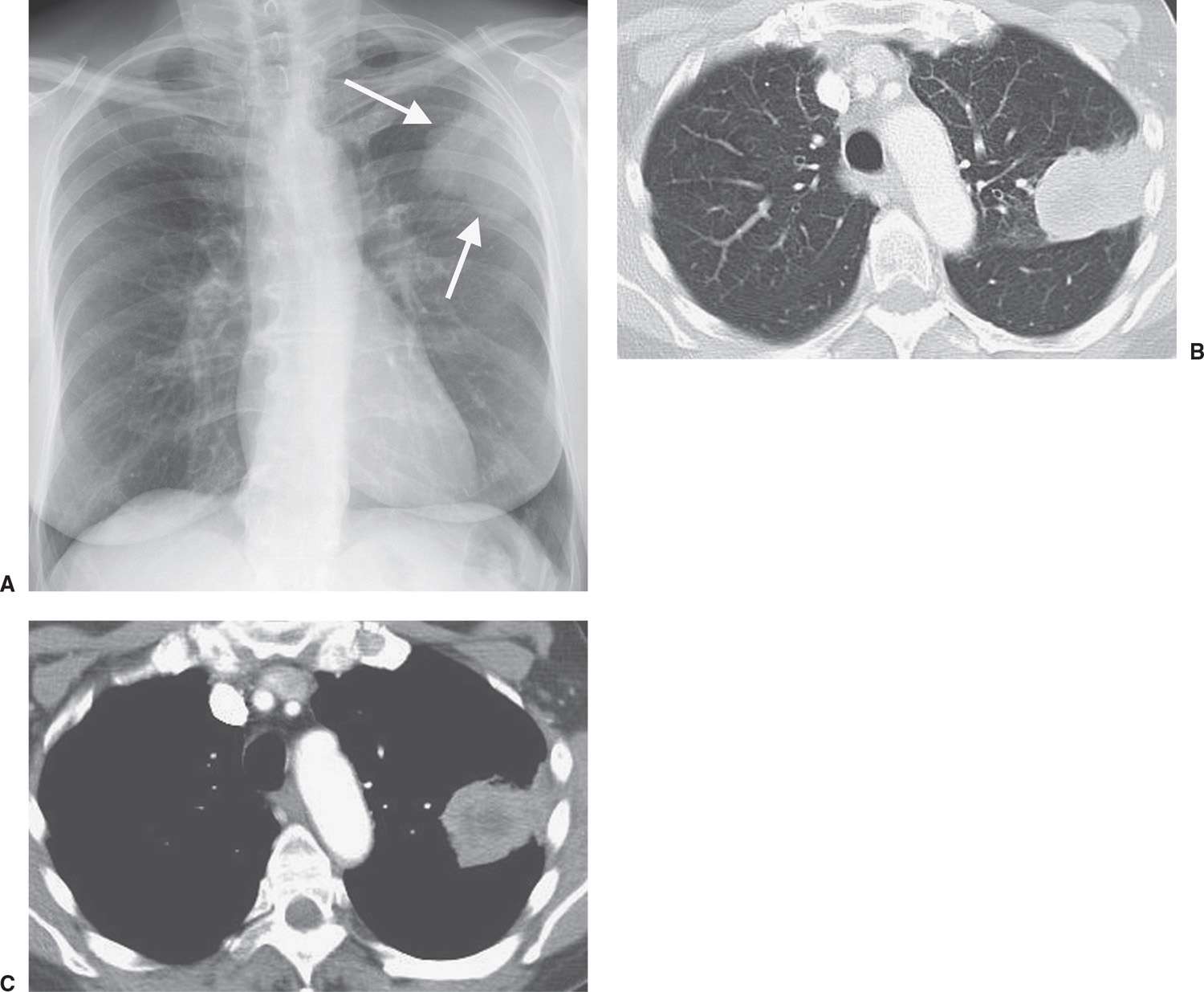 Pleura, Chest Wall, and Diaphragm Radiology Key