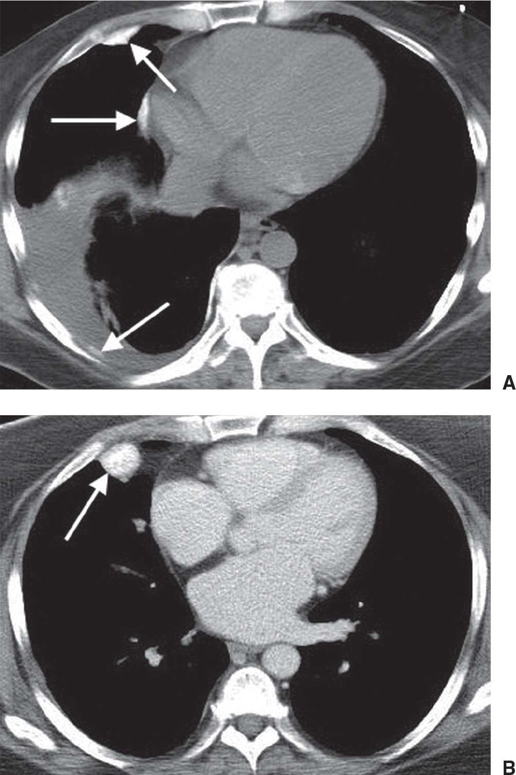 Pleura, Chest Wall, and Diaphragm Radiology Key