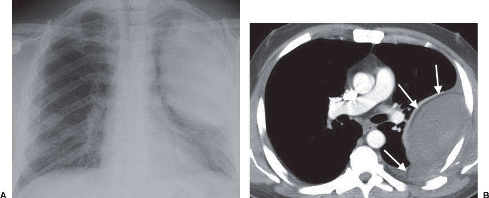 Pleura, Chest Wall, and Diaphragm Radiology Key