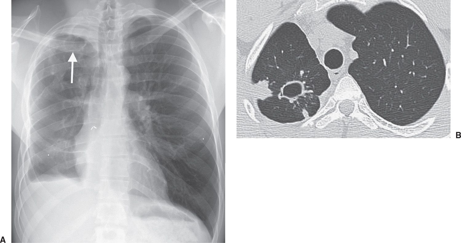 Reactivation tb on chest ct Telegraph
