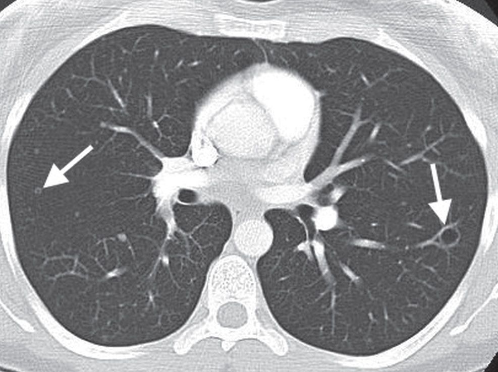Neoplasms of the Lung Radiology Key
