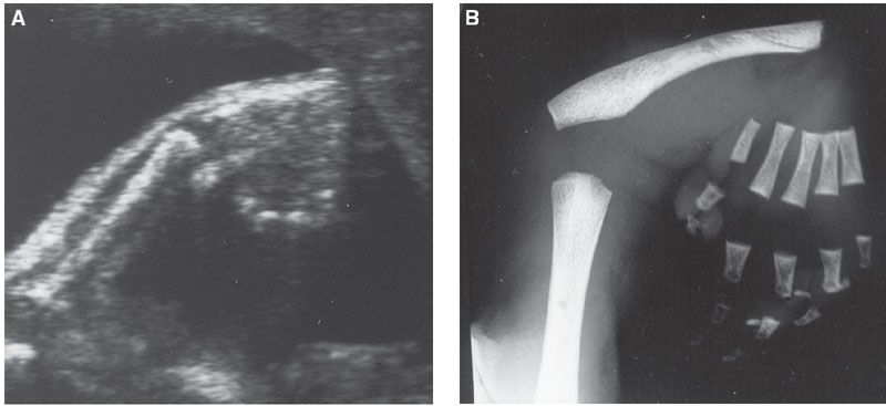 Biliary Anomalies Radiology Key