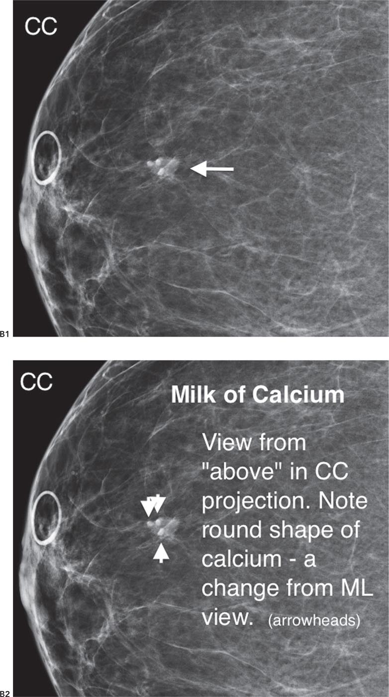 Milk Of Calcium Cyst Ultrasound