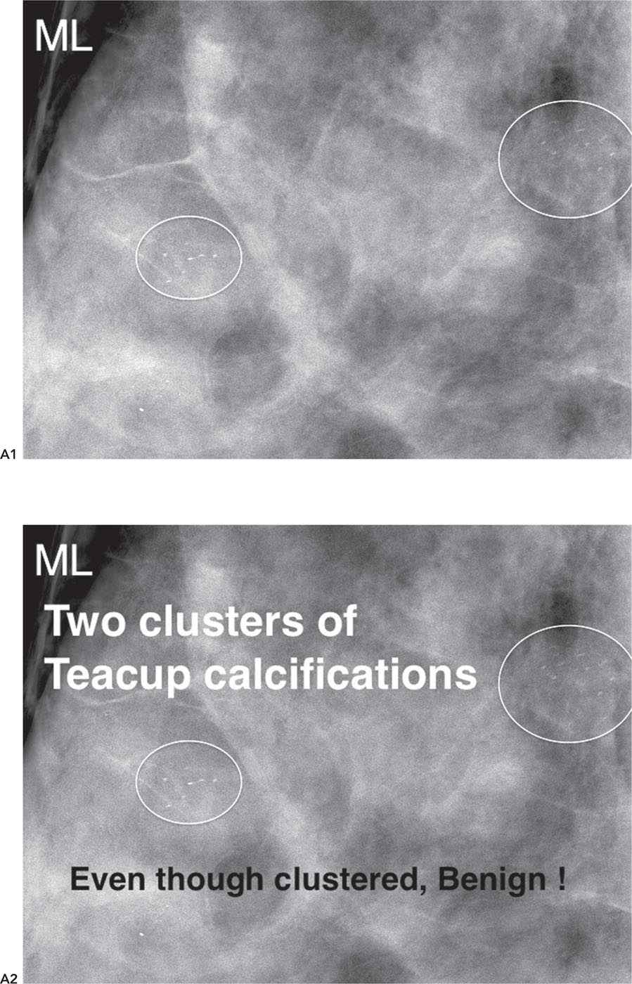 B Milk Of Calcium (Teacup) Radiology Key
