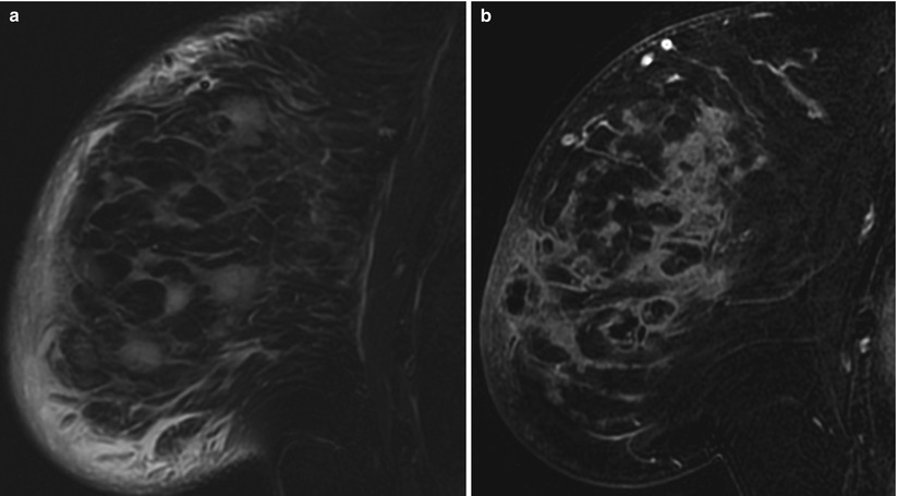 Breast Imaging On-Demand Case Reviews MRI Online