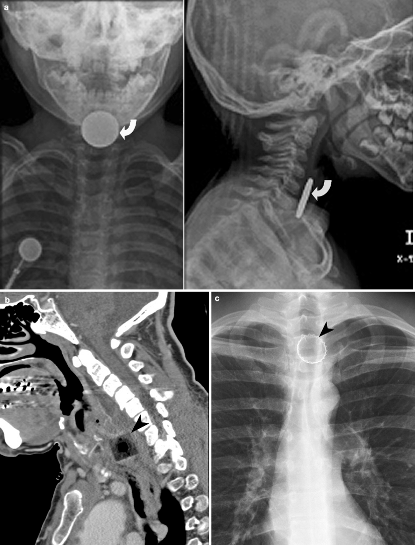 Imaging of Neck Emergencies Radiology Key