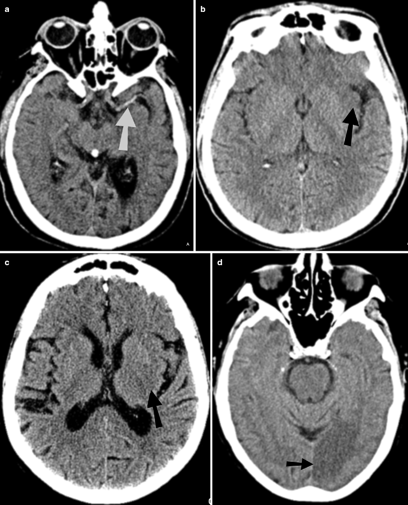 Stroke and Its Imaging Evaluation Radiology Key