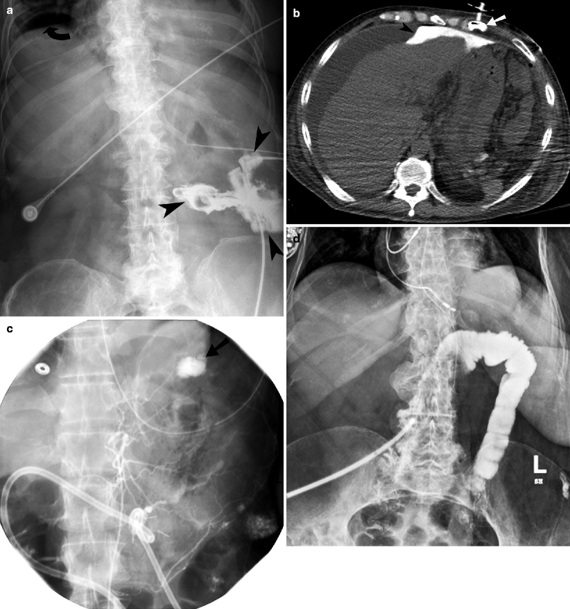 Imaging of Lines and Tubes Radiology Key