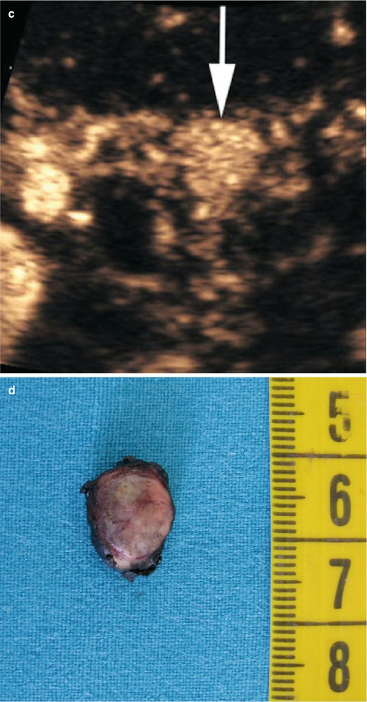 Neoplasms Radiology Key