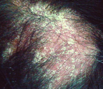 Hiv/Aids Related Skin Diseases | Radiology Key