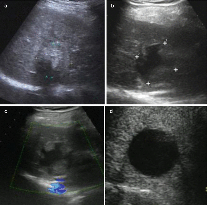 Radiological Assessment and FollowUp After Radiofrequency Ablation