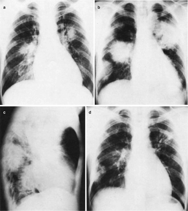 Legionnaires’ Disease Radiology Key