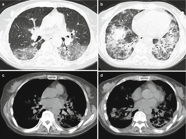 Legionella Pneumonia Legionella Pneumophila Vircell / Legionella