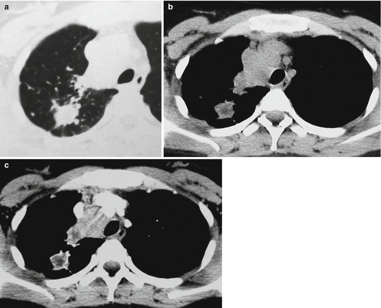 Pulmonary Tuberculosis Radiology Key