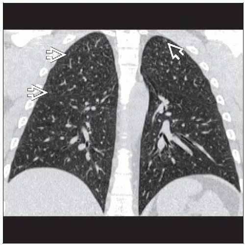 Respiratory Bronchiolitis Radiology Key