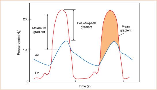 Aortic Stenosis Radiology Key