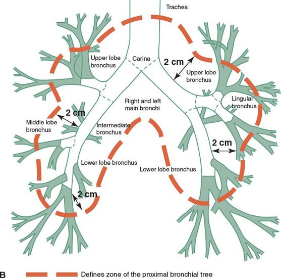 Lung Cancer Radiology Key