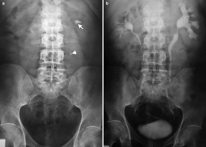 Renal Calculus Disease Radiology Key
