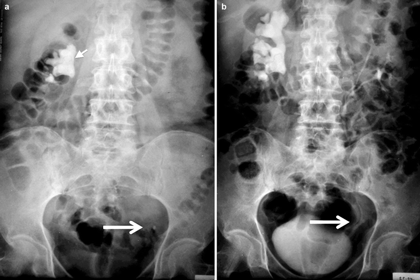Renal Calculus Disease Radiology Key