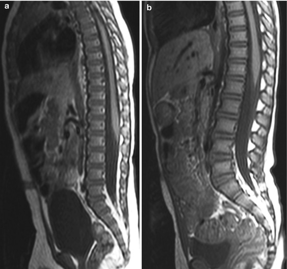 MRI of the Normal Bone Marrow Anatomic Sites Radiology Key