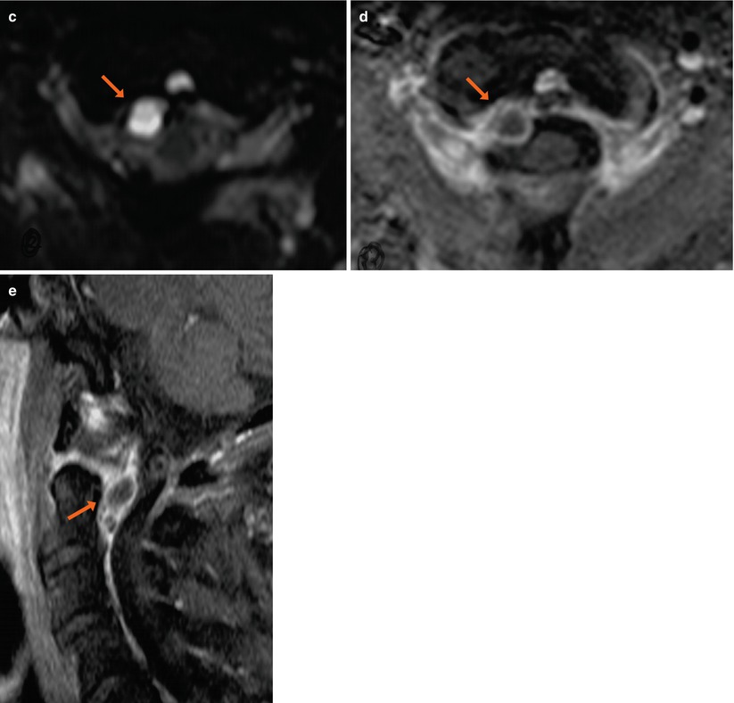 Synovial Cyst | Radiology Key