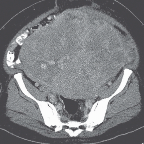 Heterogeneous Uterus On Ct Scan ct scan machine