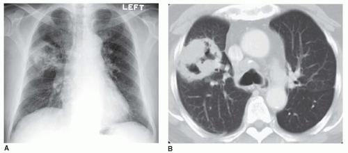 Lung Cancer and Bronchopulmonary Neoplasms Radiology Key