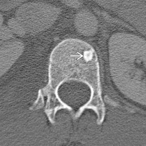 Bone Island Radiology Key