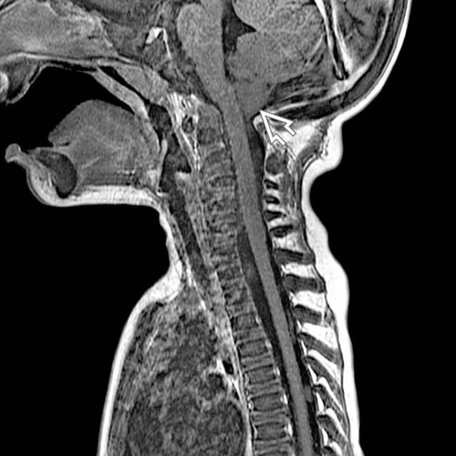 Marble Bone Disease Osteopetrosis