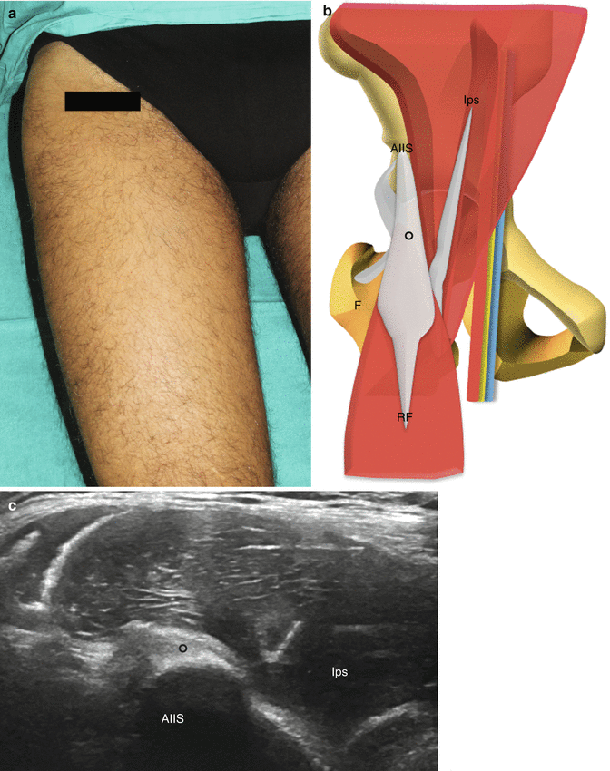 The Hip Focused Ultrasound Anatomy and Examination Technique