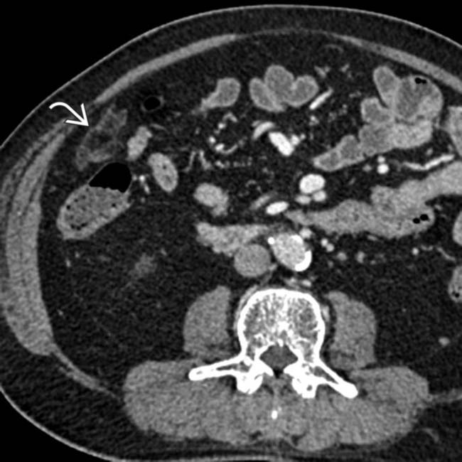 Omental Infarct Radiology Key