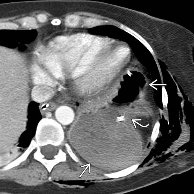 Traumatic Diaphragmatic Rupture Radiology Key
